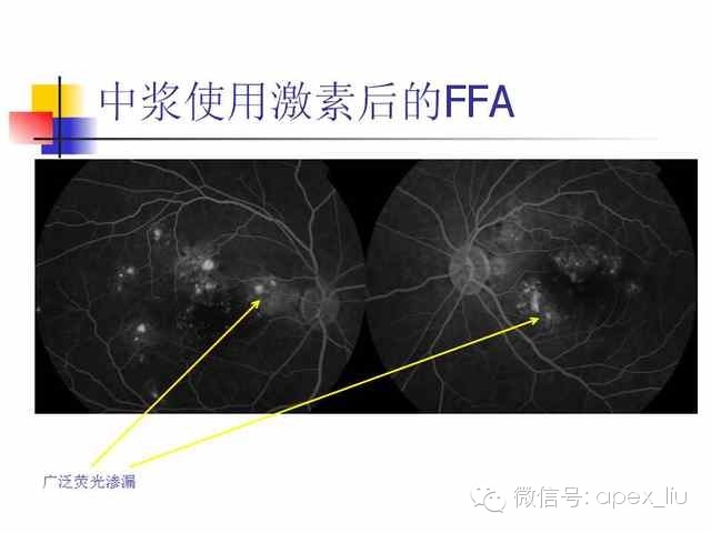 尖峰眼科课程分享之眼底造影和激光 彭志华