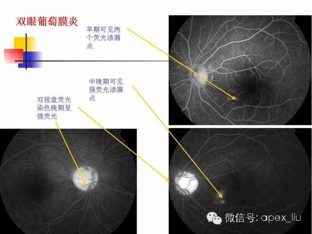 ffa如何鉴别 上个片子双眼视盘染色呈强荧光,提示葡萄膜炎可能性大.