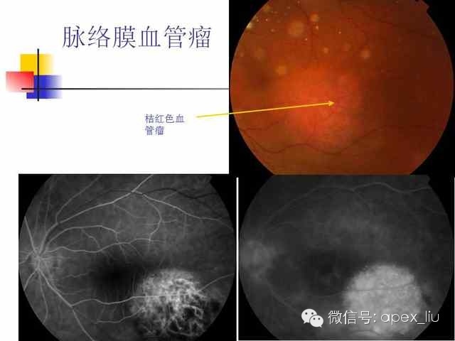 脉络膜血管瘤早期就是高荧光(问 请问肿瘤如何鉴别?答 mri)